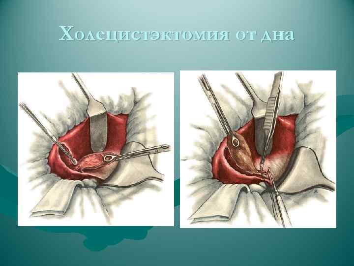 Холецистэктомия лапароскопическая фото
