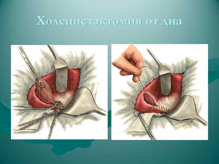Холецистэктомия от дна 