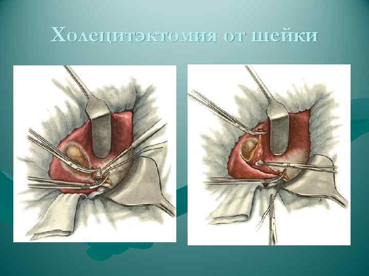 Холецитэктомия от шейки 