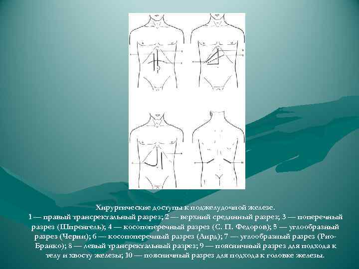 Хирургические доступы к поджелудочной железе. 1 — правый трансректальный разрез; 2 — верхний срединный