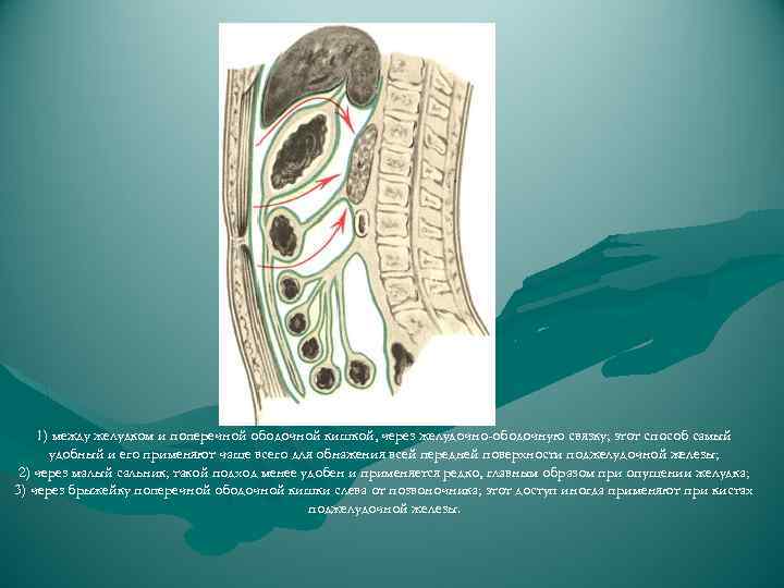 1) между желудком и поперечной ободочной кишкой, через желудочно-ободочную связку; этот способ самый удобный