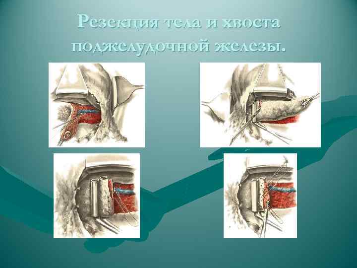 Резекция тела и хвоста поджелудочной железы. 