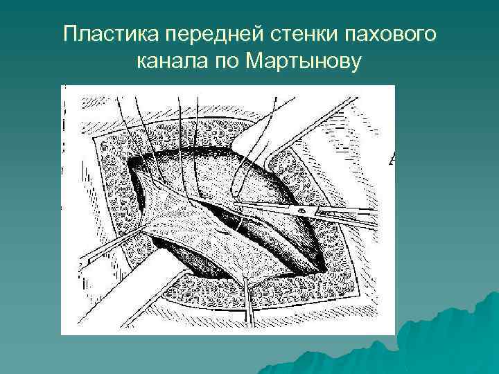 Пластика передней стенки пахового канала по Мартынову 