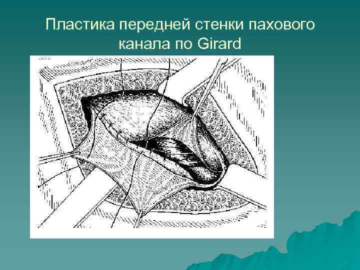 Пластика передней стенки пахового канала по Girard 