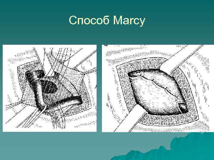 Способ Marcy 