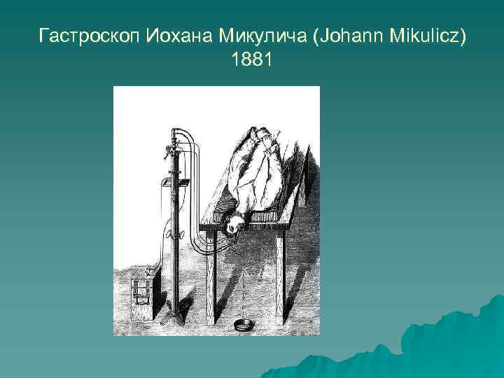 Гастроскоп Иохана Микулича (Johann Mikulicz) 1881 