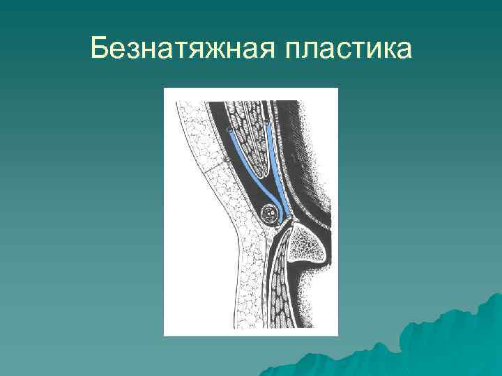 Безнатяжная пластика 