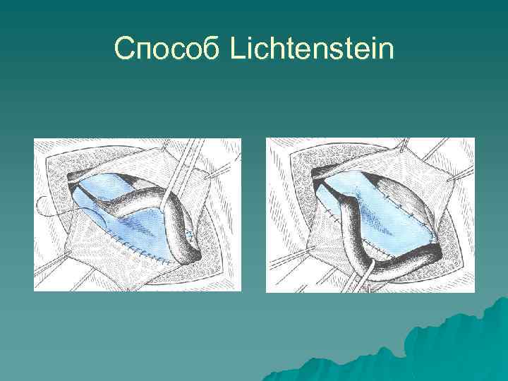 Способ Lichtenstein 