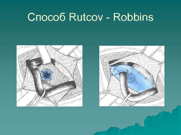 Способ Rutcov - Robbins 