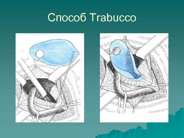 Способ Trabucco 