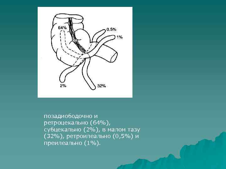 позадиободочно и ретроцекально (64%), субцекально (2%), в малом тазу (32%), ретроилеально (0, 5%) и