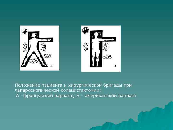 Положение пациента и хирургической бригады при лапароскопической холецистэктомии: А –французский вариант; Б – американский