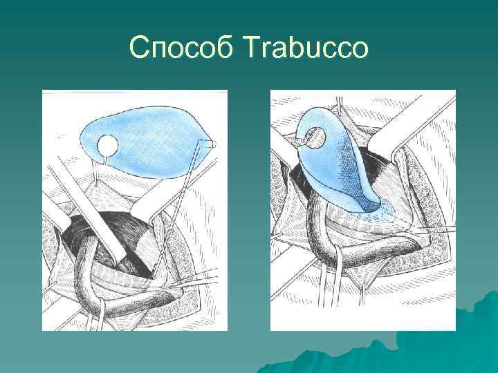 Способ Trabucco 