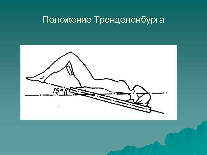 Положение Тренделенбурга 