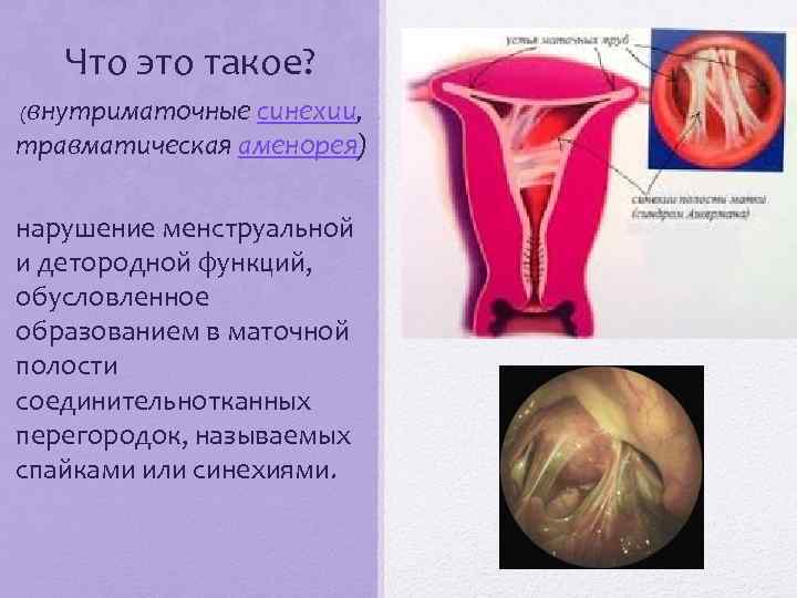 Что это такое? (внутриматочные синехии, травматическая аменорея) нарушение менструальной и детородной функций, обусловленное образованием