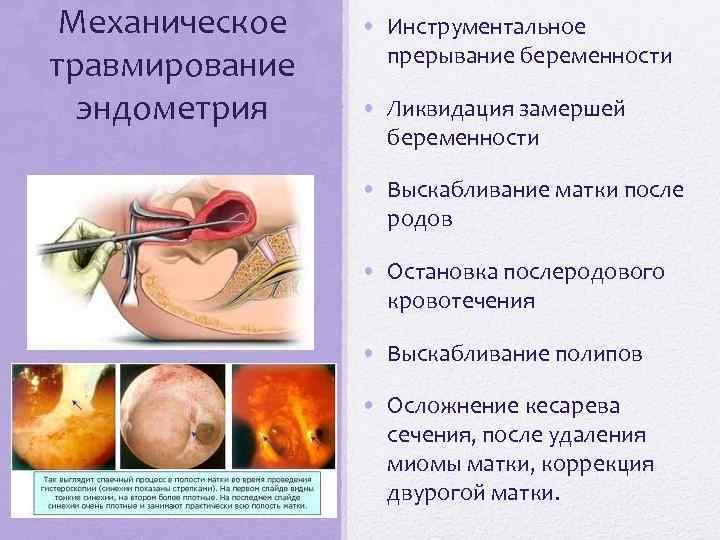 Механическое травмирование эндометрия • Инструментальное прерывание беременности • Ликвидация замершей беременности • Выскабливание матки