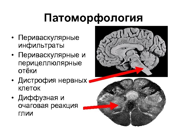 Патоморфология • Периваскулярные инфильтраты • Периваскулярные и перицеллюлярные отёки • Дистрофия нервных клеток •