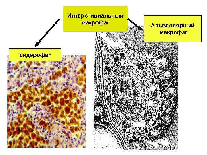 Интерстициальный макрофаг сидерофаг Альвеолярный макрофаг 