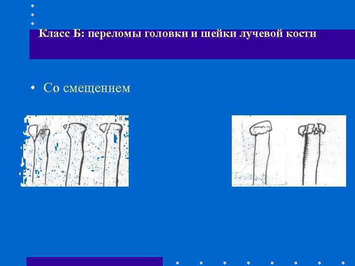 Класс Б: переломы головки и шейки лучевой кости • Со смещением 