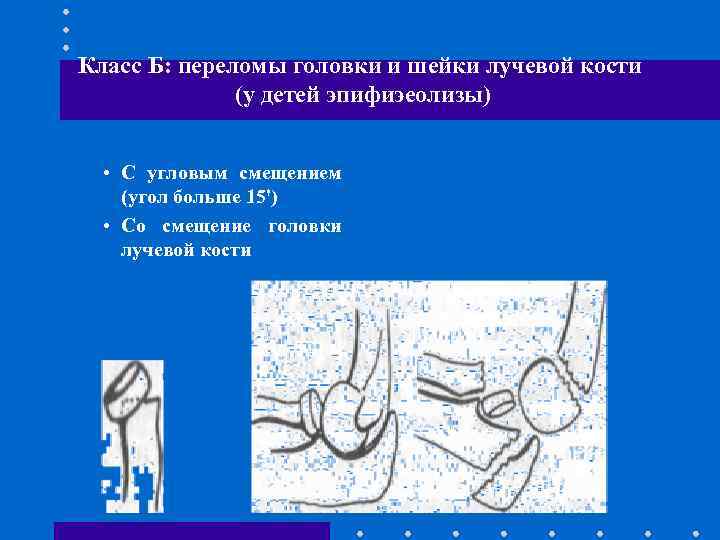 Класс Б: переломы головки и шейки лучевой кости (у детей эпифиэеолизы) • С угловым