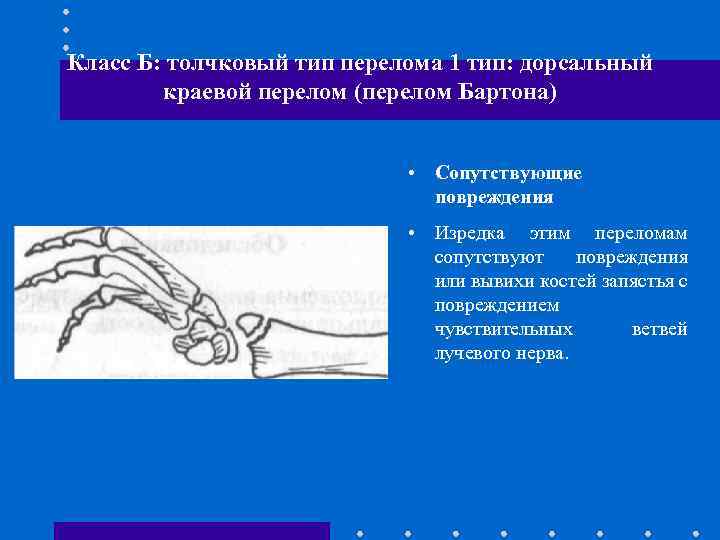 Перелом предплечья травматология презентация