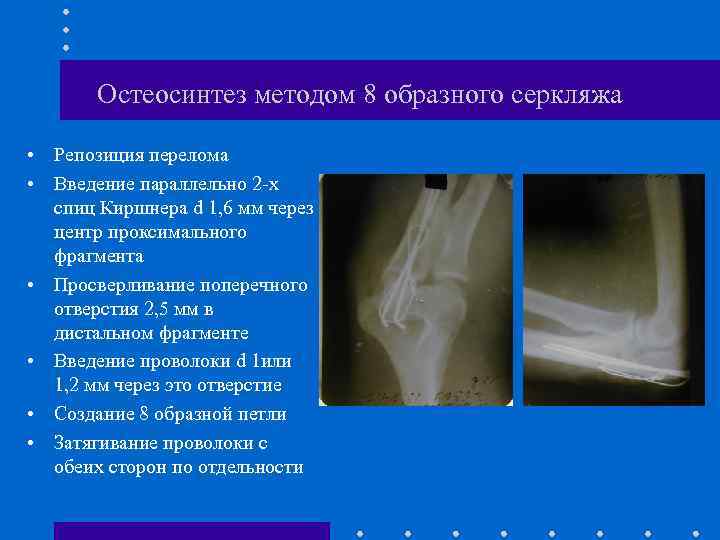 Остеосинтез методом 8 образного серкляжа • Репозиция перелома • Введение параллельно 2 -х спиц