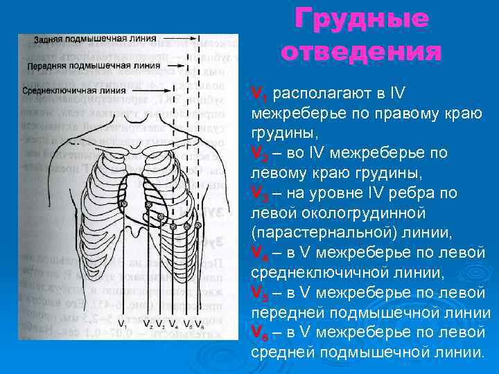 Грудные отведения V 1 располагают в IV межреберье по правому краю грудины, V 2