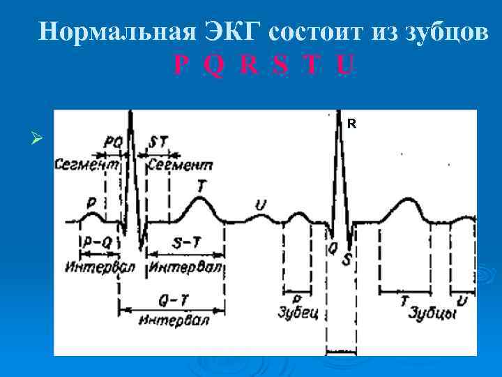 Нормальная ЭКГ состоит из зубцов P Q R S Т U Ø R 