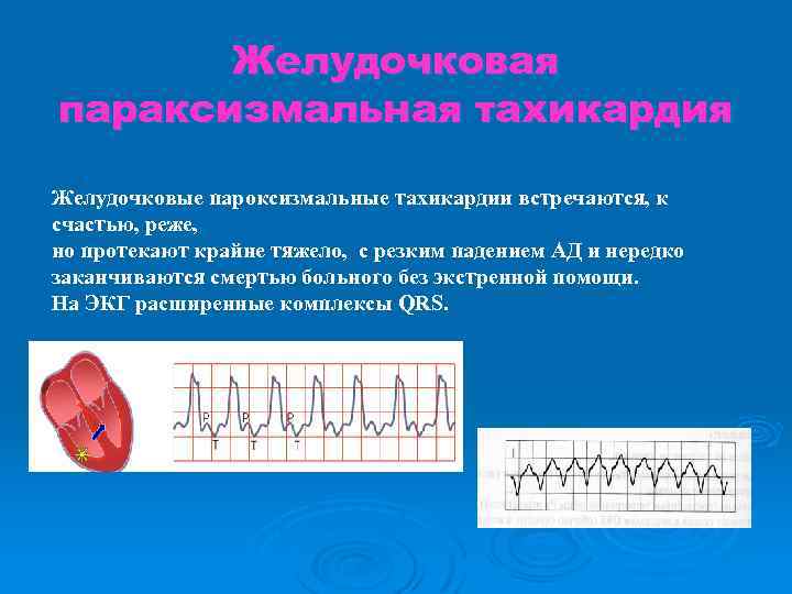 Желудочковая параксизмальная тахикардия Желудочковые пароксизмальные тахикардии встречаются, к счастью, реже, но протекают крайне тяжело,