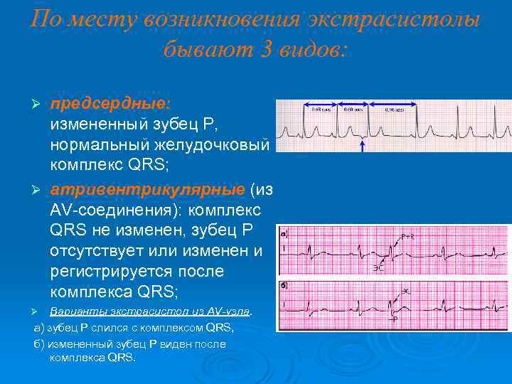 По месту возникновения экстрасистолы бывают 3 видов: предсердные: измененный зубец P, нормальный желудочковый комплекс