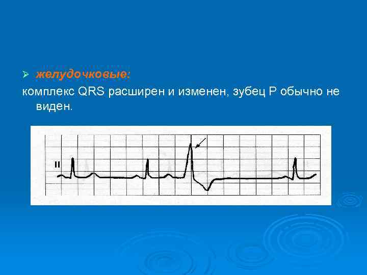 желудочковые: комплекс QRS расширен и изменен, зубец P обычно не виден. Ø 