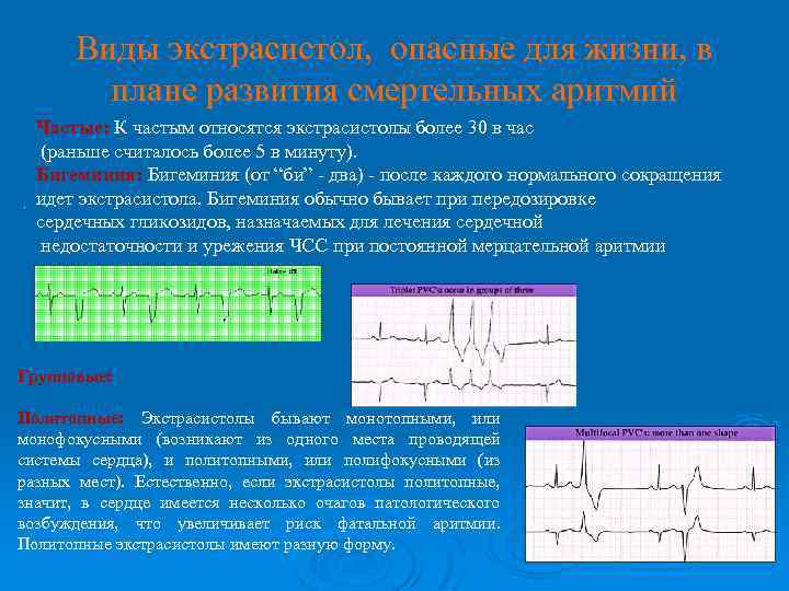 Виды экстрасистол, опасные для жизни, в плане развития смертельных аритмий. Частые: К частым относятся