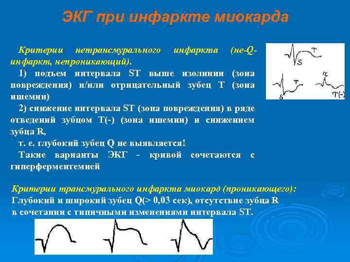 ЭКГ при инфаркте миокарда Критерии нетрансмурального инфаркта (не-Qинфаркт, непроникающий). 1) подъем интервала ST выше