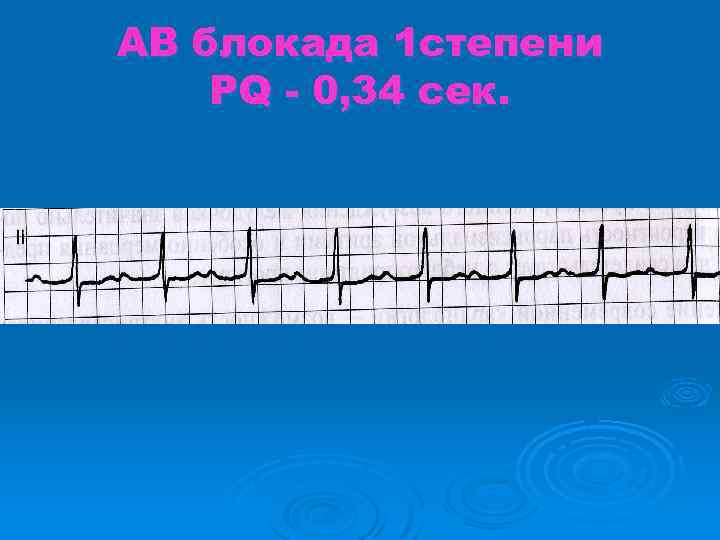 АВ блокада 1 степени PQ - 0, 34 сек. 