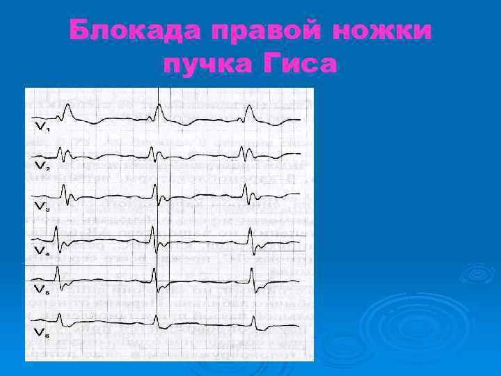 Блокада правой ножки пучка Гиса 