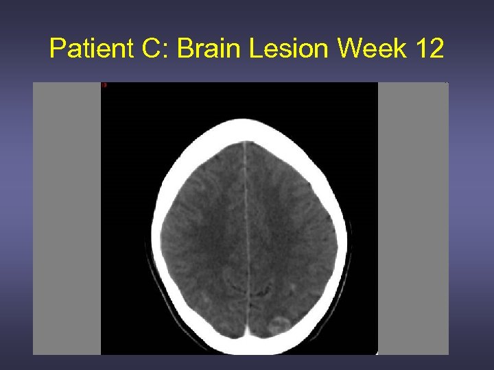 Patient C: Brain Lesion Week 12 