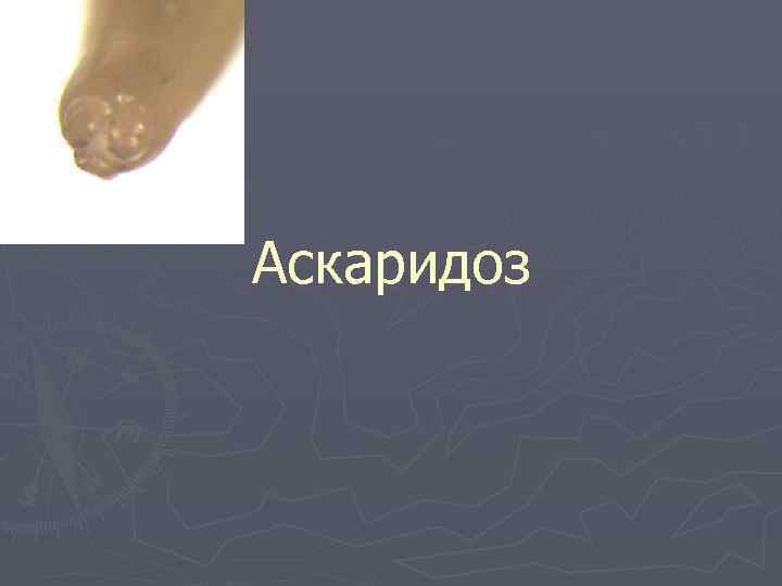 Аскаридоз 