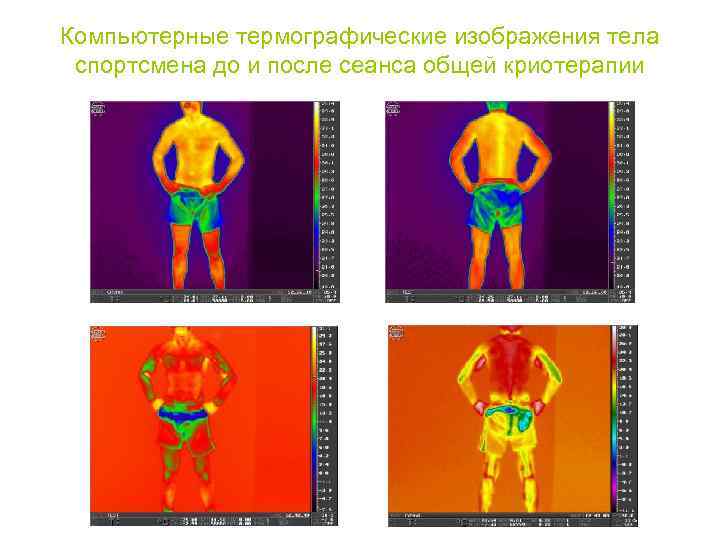Компьютерные термографические изображения тела спортсмена до и после сеанса общей криотерапии 