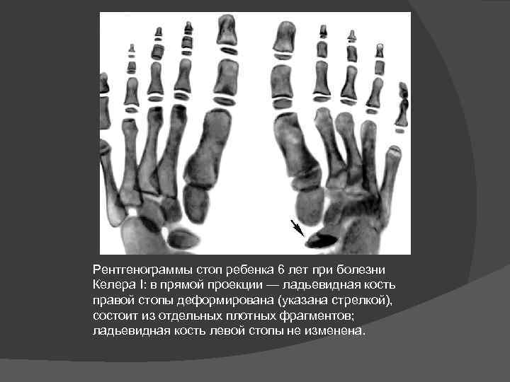 Рентген в 2 проекциях. Болезнь Альбана Келера. Ладьевидная кость стопы болезнь Келлера. Остеохондропатия Келлера 1 рентген. Остеохондропатия Келлера 2.