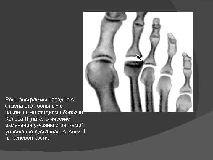 Болезнь келлера стопы. Остеохондропатия головки плюсневой кости рентген. Остеохондропатия Келлера 1 рентген. Остеохондропатия 2 плюсневой кости стопы рентген.