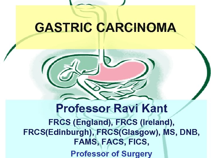 GASTRIC CARCINOMA Professor Ravi Kant FRCS (England), FRCS (Ireland), FRCS(Edinburgh), FRCS(Glasgow), MS, DNB, FAMS,