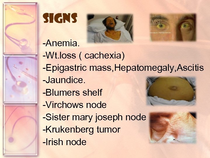 signs -Anemia. -Wt. loss ( cachexia) -Epigastric mass, Hepatomegaly, Ascitis -Jaundice. -Blumers shelf -Virchows