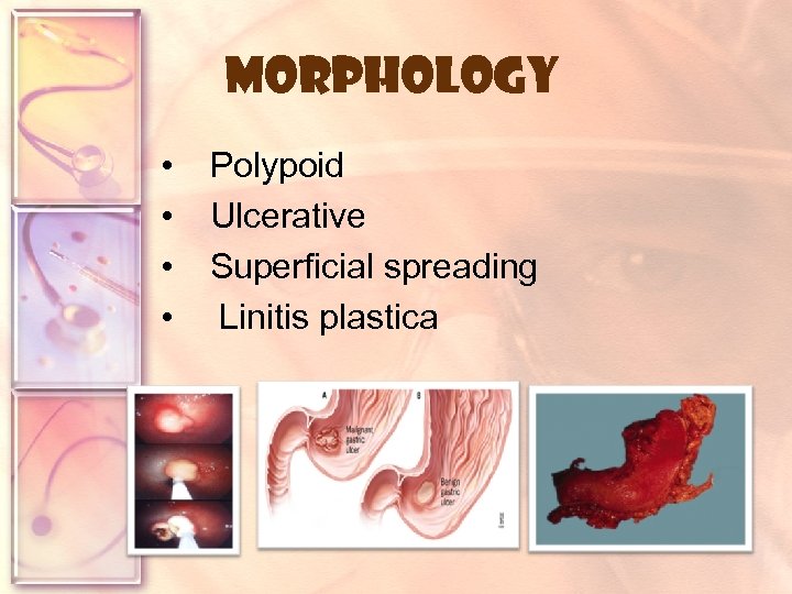 Morphology • • Polypoid Ulcerative Superficial spreading Linitis plastica 