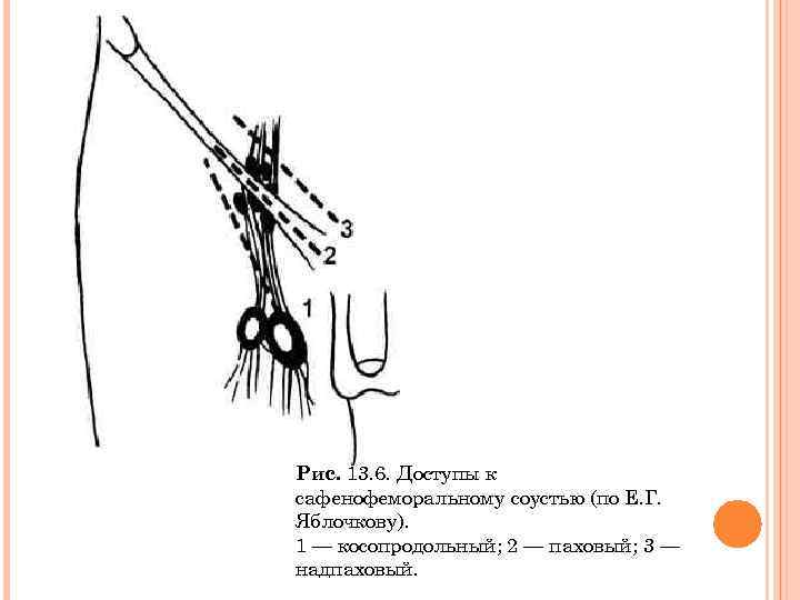 Рис. 13. 6. Доступы к сафенофеморальному соустью (по Е. Г. Яблочкову). 1 — косопродольный;