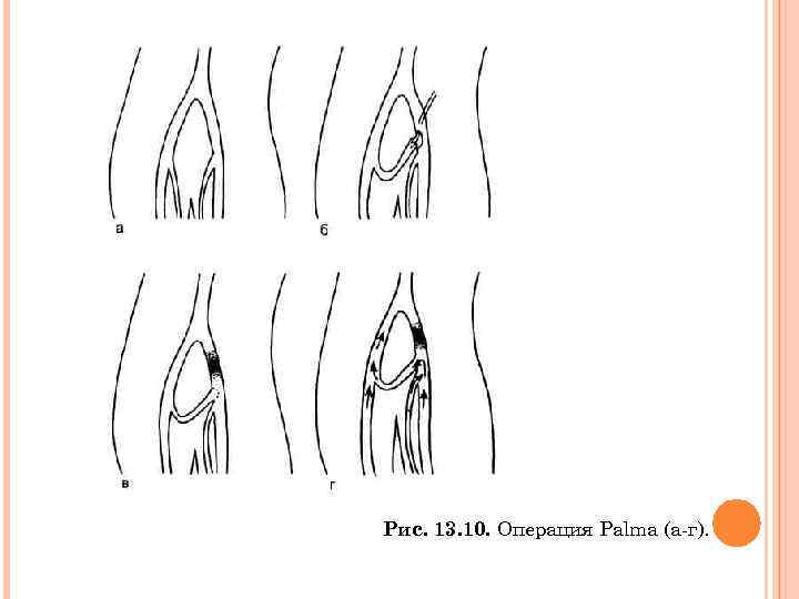 Рис. 13. 10. Операция Palma (а г). 