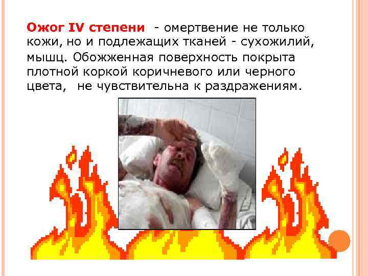 Ожог IV степени - омертвение не только кожи, но и подлежащих тканей - сухожилий,