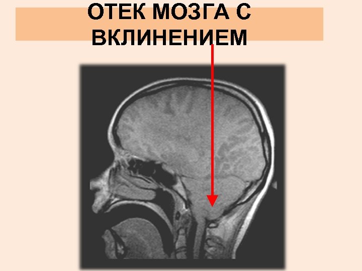 ОТЕК МОЗГА С ВКЛИНЕНИЕМ 