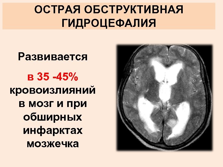 ОСТРАЯ ОБСТРУКТИВНАЯ ГИДРОЦЕФАЛИЯ Развивается в 35 -45% кровоизлияний в мозг и при обширных инфарктах