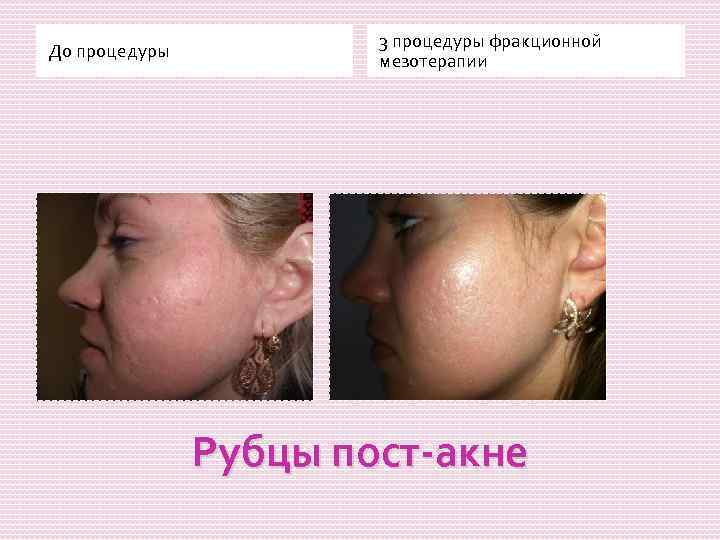 До процедуры 3 процедуры фракционной мезотерапии Рубцы пост-акне 