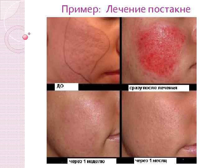 Пример: Лечение постакне 
